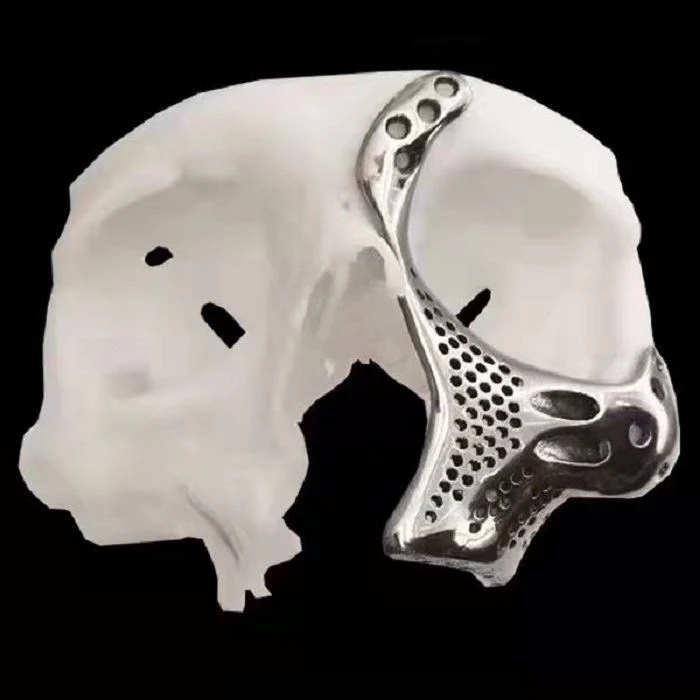 3D Printing in Orthopedic Implant